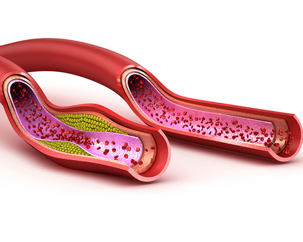 ازمایش انواع چربی Cholesterol Test (Lipid Panel)